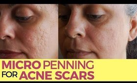 Acne Scar Treatment With Micropenning