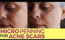 Acne Scar Treatment With Micropenning