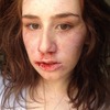 Infection