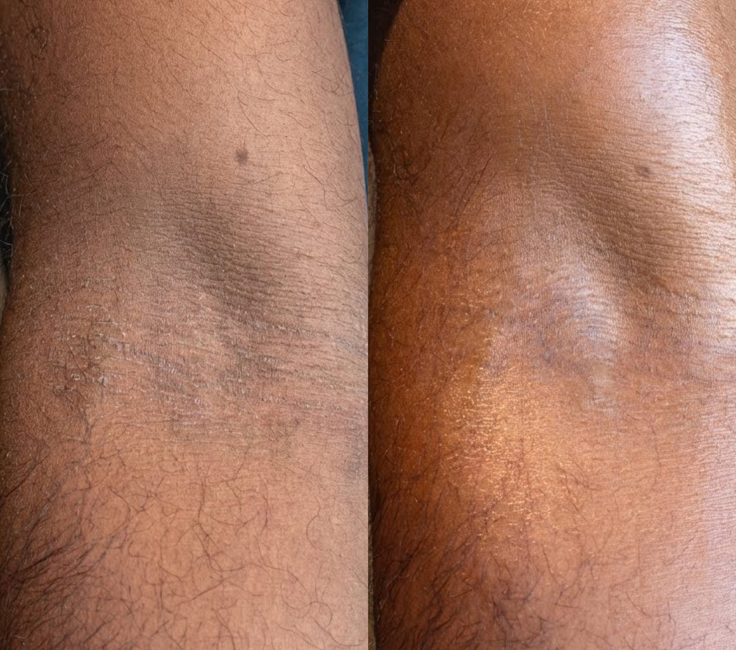 Before and after using the Resurfacing Body Lotion