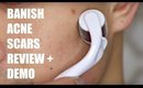 ACNE SCAR REMOVAL | BANISH ACNE SCARS DEMO + REVIEW