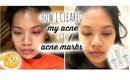 How I Cleared my Acne & Acne Marks/Skin Care Routine | makeupbyritz