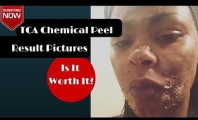 TCA Chemical Peeling Pictures And Results (30%) DivasGlamSquad