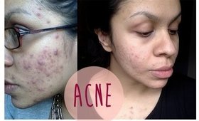 HOW TO: Get Rid Of Acne, Tips & Tricks | TheRaviOsahn