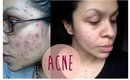 HOW TO: Get Rid Of Acne, Tips & Tricks | TheRaviOsahn