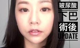 玻尿酸下巴療程術後注意事項、保養＆三個月後的心得｜Mioggi Juvederm facial filler treatment Post-Op Update｜Nabibuzz娜比