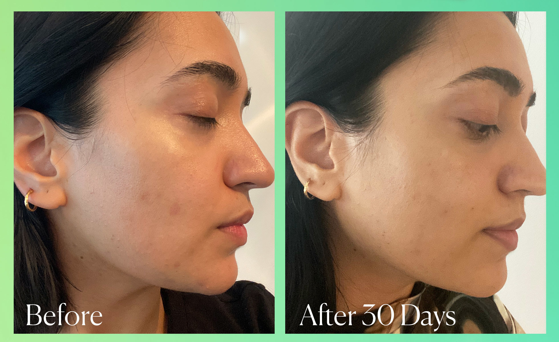 Nurain’s results after 30 days of using Good Molecules Discoloration Correcting Serum.