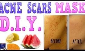 How to REMOVE ACNE PIMPLE SCARS FAST naturally at home for blemishes herbal home remedy treatment