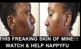Worst Acne Breakout Ever: Update