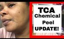 How To Use TCA Chemical Peel At Home Update Day 3 & 4