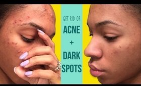 How I Get Rid of Acne and Fade Dark Spots! ▸ VICKYLOGAN