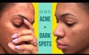 How I Get Rid of Acne and Fade Dark Spots! ▸ VICKYLOGAN