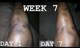 Lactic Acid:Fading Surgery Scars | WEEK 7 | Demo + Result Pics