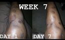 Lactic Acid:Fading Surgery Scars | WEEK 7 | Demo + Result Pics