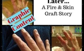 GRAPHIC PHOTOS | 5 Years Later...A Fire/Skin Graft Story