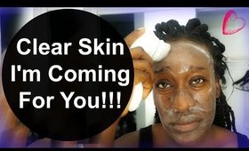 Daily Skin Care Routine on Adult Acne Skin: SkinTime With Nappyfu