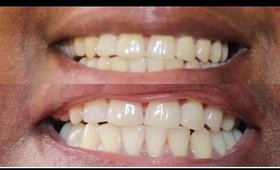 Smile Brilliant Teeth Whitening