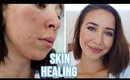 HOW I CLEARED MY SKIN FAST: Acne Healing & Anti Aging