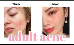 MY ADULT ACNE STORY  ✨HOW I GOT RID OF MY ADULT ACNE + BIRTH CONTROL