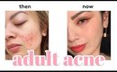 MY ADULT ACNE STORY  ✨HOW I GOT RID OF MY ADULT ACNE + BIRTH CONTROL