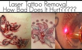 Laser Tattoo Removal | How Bad Does It Hurt? | First Session