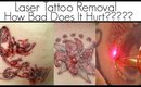 Laser Tattoo Removal | How Bad Does It Hurt? | First Session