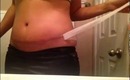 Tummy Tuck Post-op 3 weeks Later