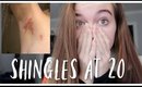 Getting Shingles At 20 Years Old