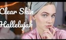 How I Got Clear Skin | My Story ♡