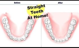 How To Get Straight Teeth At Home | Invisible Aligners Update