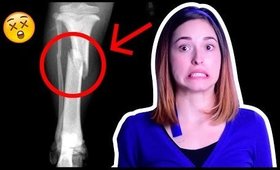 Mis Accidentes MÁS DOLOROSOS #Storytime | Kika Nieto