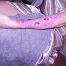 Severe Bruise