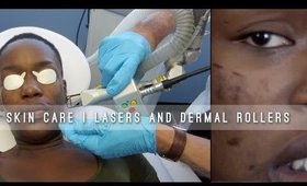 Removing Hyper Pigmentation | Lasers vs Skin Needling Which do I prefer NEW SKin care methods