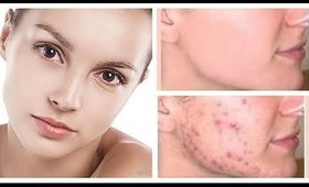 1 Magic Ingredient to Get Rid of Acne Overnight |100% Works