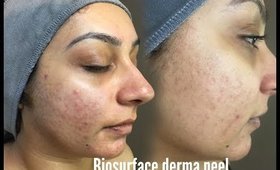 I'm back! Biosurface derma peel my experience