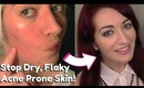 • HOW TO: Remove Dry Flaky Skin | Dry & Acne Prone Skin Care | Skin Tip Tuesday! •