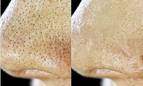 How to _ Get Rid Of LARGE Open PORES? _ | (GET Younger, Smoother & Tighter Skin!)