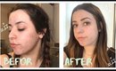 My Skincare Routine for Severe Acne and Scarring