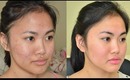 Accutane || 3 months