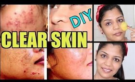 DIY Facemask for Acne Treatment | Get Clear & Bright Skin