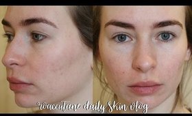 ROACCUTANE DAILY SKIN VLOG - MONTH 7