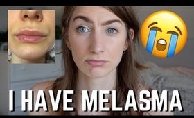 I HAVE MELASMA 😭