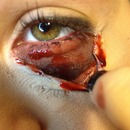I ripped my eyelid off AH!