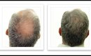 Breakthrough in Hair Loss (1.1)