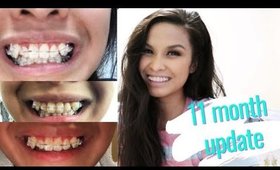 11 MONTH BRACES UPDATE | HIGH CANINES