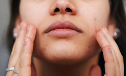 Fungal Acne 101: Symptoms, Causes, and Treatments
