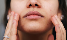 Fungal Acne 101: Symptoms, Causes, and Treatments