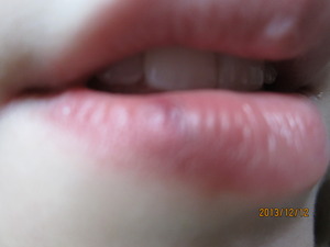 My current split lip. Sorry it is kind of fuzzy my camera wouldn't focus. 