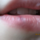 Split lip