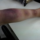 Stages of bruising